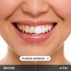 Kit blanchiment des dents LED – Résultat rapide à domicile thumb 3