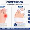 Attelle pour hallux valgus, Correcteur du gros orteil thumb 14