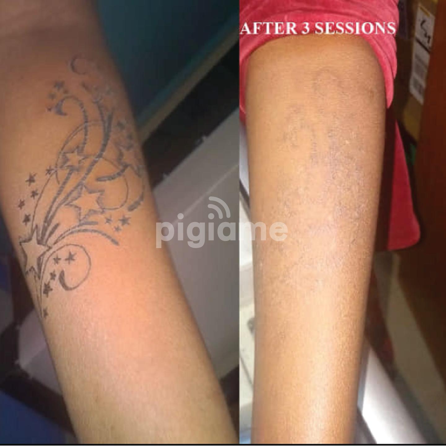 Laser Tattoo Removal | Dionysiou Medi Spa Limassol - Cyprus