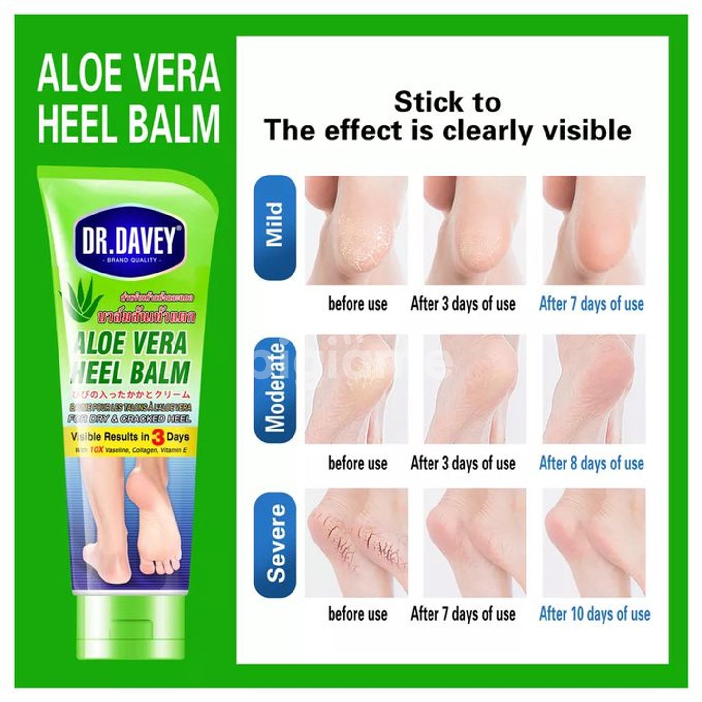 Globus Naturals For Dry Cracked Heels & Feet Enriched With Aloe Vera, Neem  & Anantmool Crack Cream (50g)