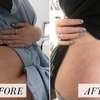 BEST STRETCH MARKS REMOVAL thumb 2