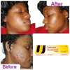 Tretinoin Acnesol Cream Treats Acne & Pimples thumb 2