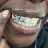 Sivler and gold teeth thumb 1