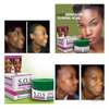 SOS Zero Acne Face Cream-Treats Acne,Pimples&Darkspots thumb 2