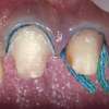 DENTAL RETRACTION CORD (SIZE 1) NAIROBI,KENYA thumb 0