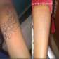 Tattoo Removal Laser