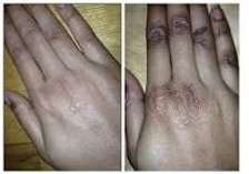 Get Rid of Dark Knuckles