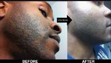 After Shave Pimples and Zits Remover by Acne Care Kenya