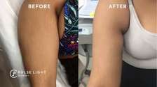BEST STRETCH MARKS REMOVAL