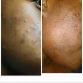 Acne Treatment Kit by Acne Care