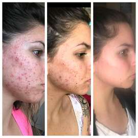 Acne treatment kit