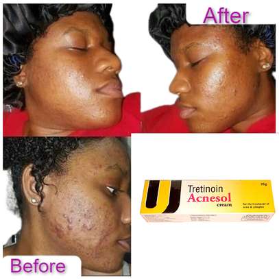 Tretinoin Acnesol Cream Treats Acne & Pimples image 3