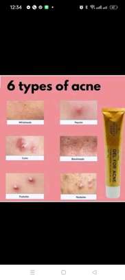 Kennite acne gel image 5