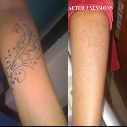 Tattoo Removal Laser image 1