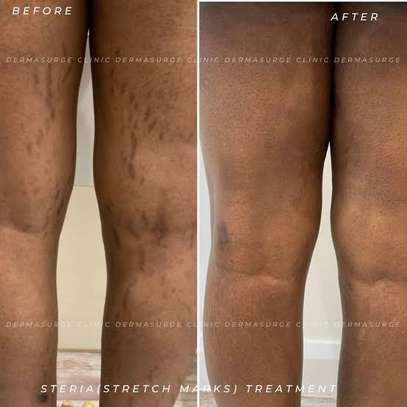 BEST STRETCH MARKS REMOVAL image 2