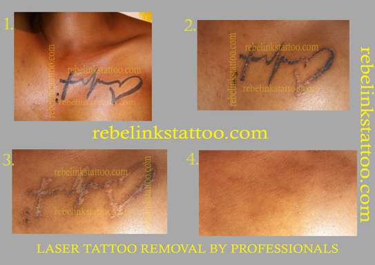 Laser Tattoo Removal image 2