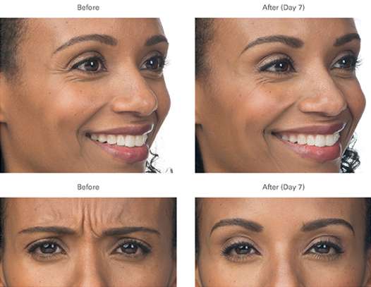 Top quality  Skin Treatments (xeomin Botox juvederm ) image 2