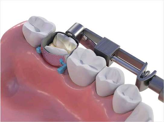 DENTAL MATRIX BAND PRICE IN KENYA image 2