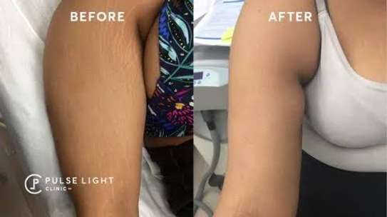 BEST STRETCH MARKS REMOVAL image 1