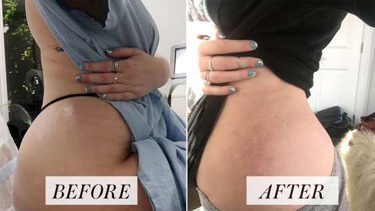 BEST STRETCH MARKS REMOVAL image 3
