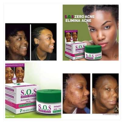 SOS Zero Acne Face Cream-Treats Acne,Pimples&Darkspots image 3