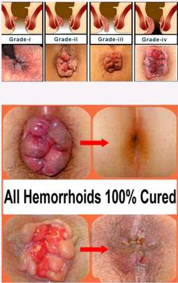 Herbal hemorrhoids  spray image 6