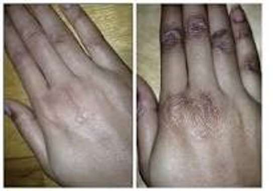 Get Rid of Dark Knuckles image 1
