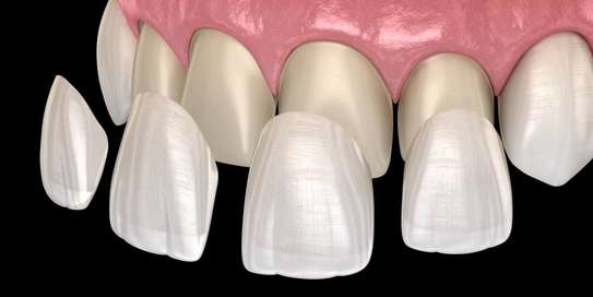 DENTAL CERAMICS 11 FOR SALE PRICES NAIROBI,KENYA image 1