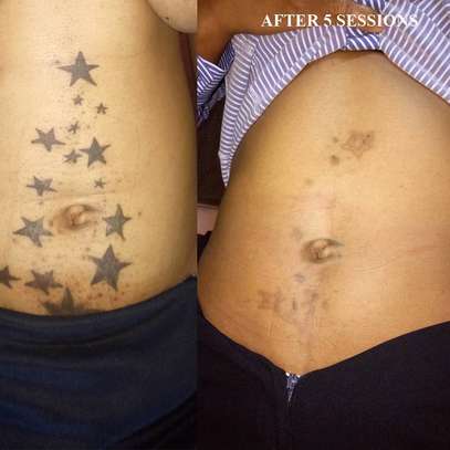 Tattoo Removal Laser image 3