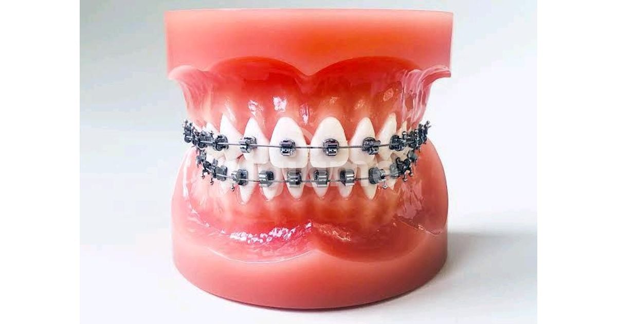 Buy Dental Braces Sale Price Near Me Nairobi Kenya in Nairobi CBD PigiaMe